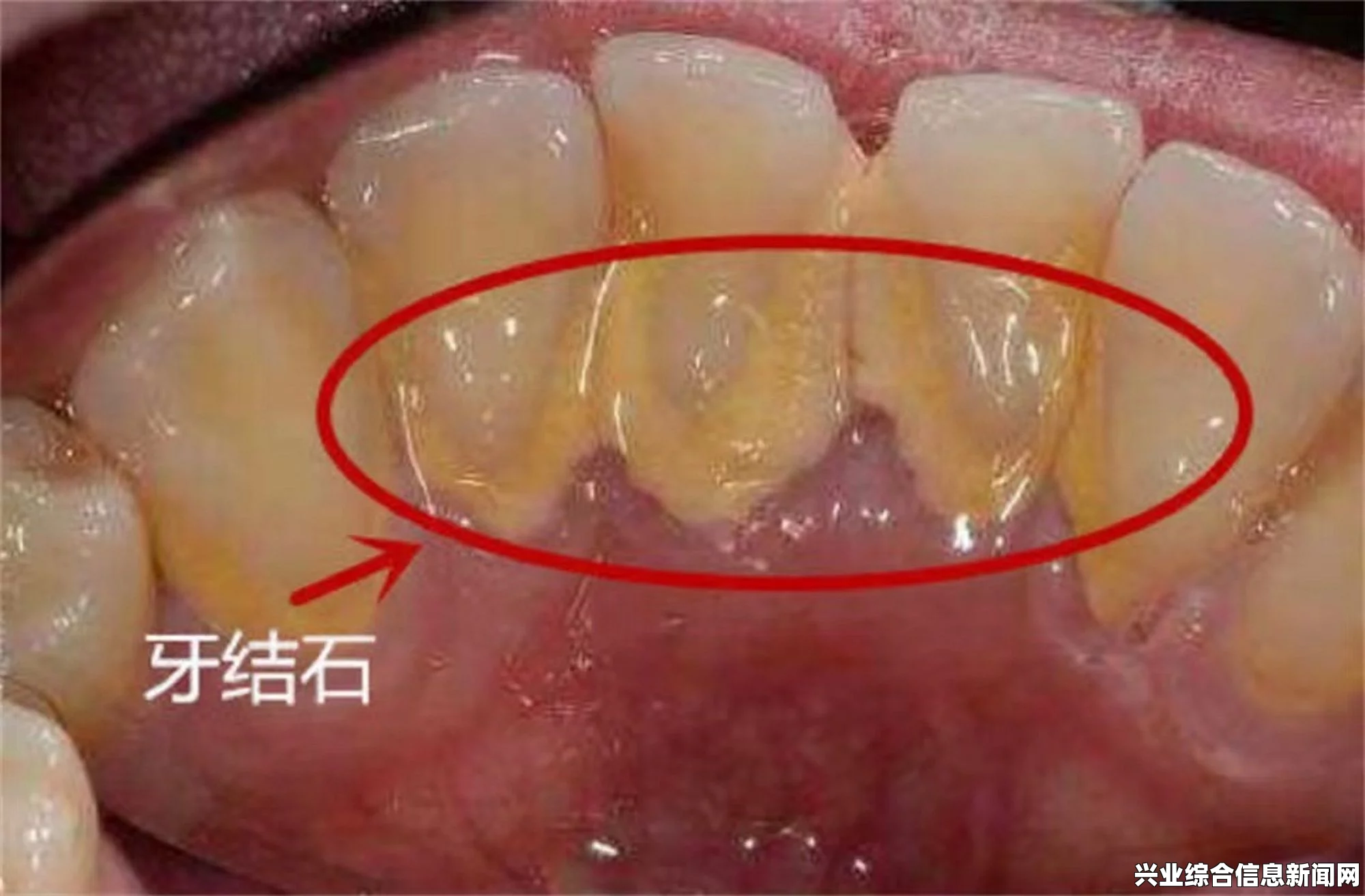 牙结石去除全攻略，轻松摆脱牙结石的详细指南