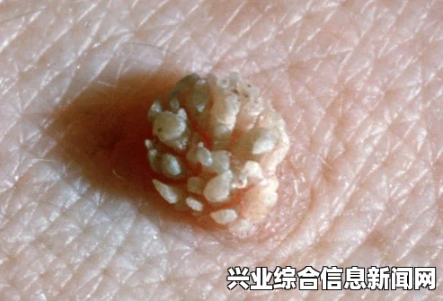 HPV 感染症状全解析