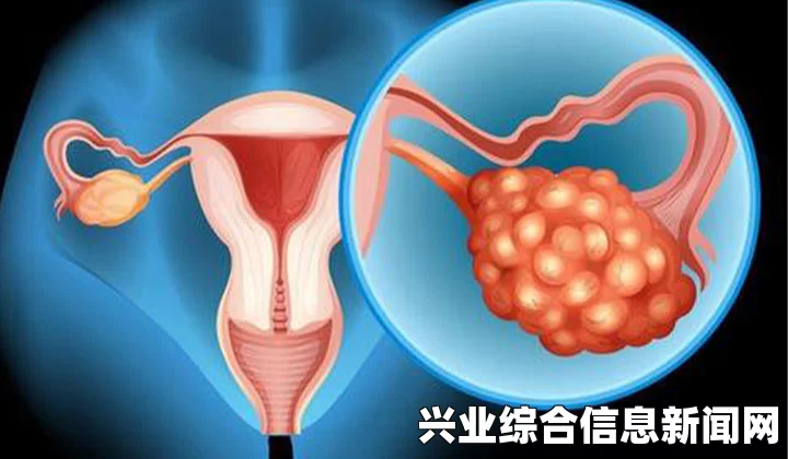 卵巢囊肿对怀孕的影响全面剖析及应对之策